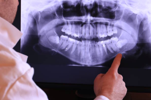Best Knocked-Out Tooth (Avulsed Tooth) Treatment in Cadillac, MI