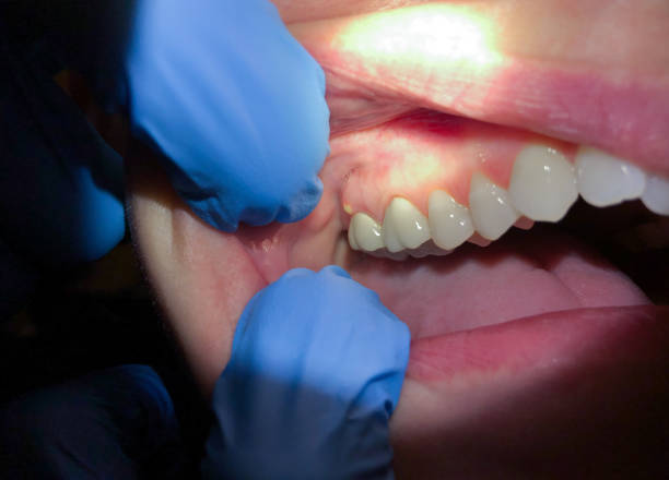 Best Emergency Root Canal Therapy in Cadillac, MI